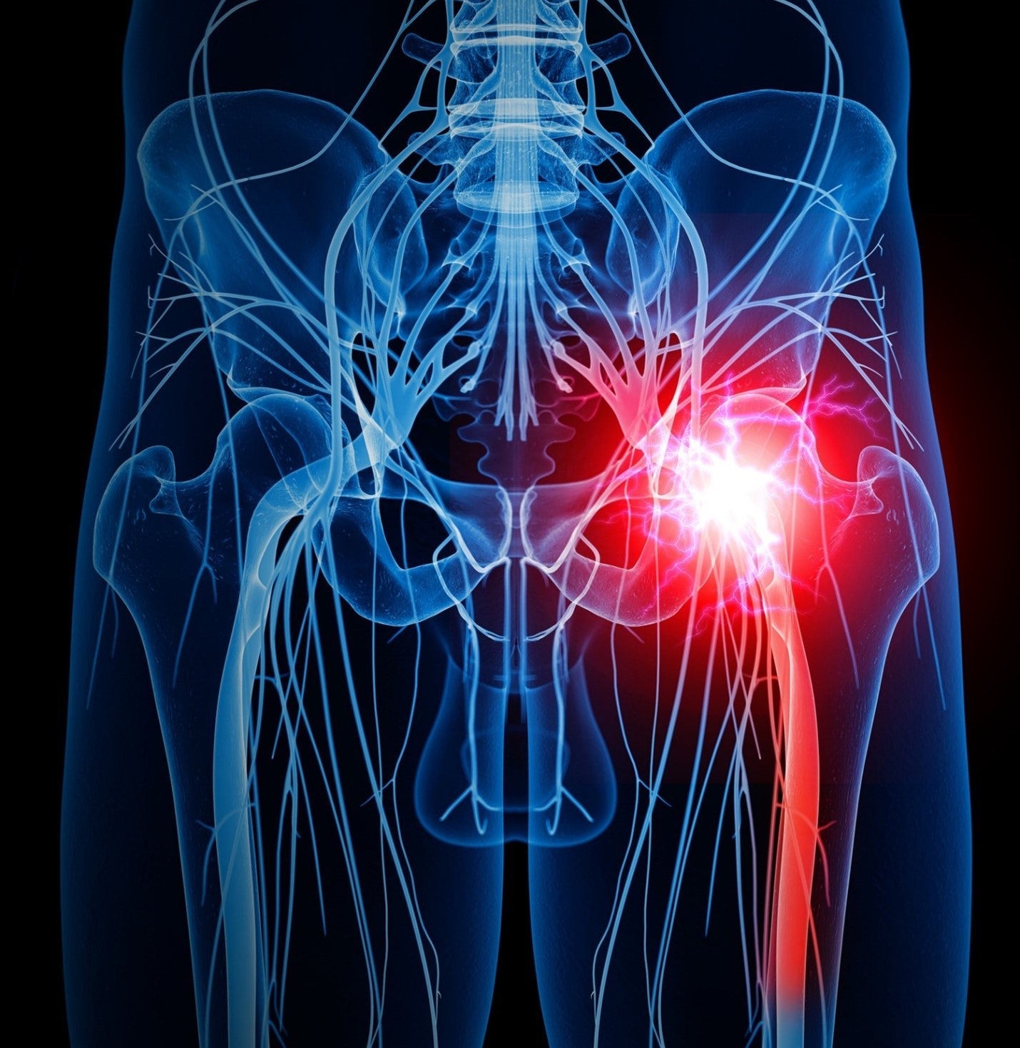 Percutane and Traumitane best relief for sciatica 