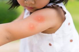 Traumitane best relief for insect bites